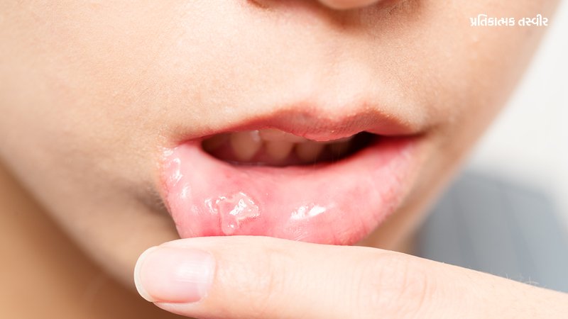 Mouth-Ulcer.jpg