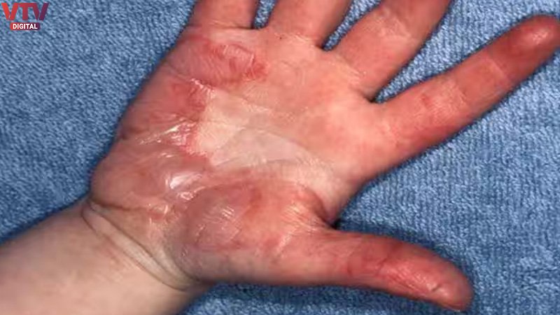 SKIN-00