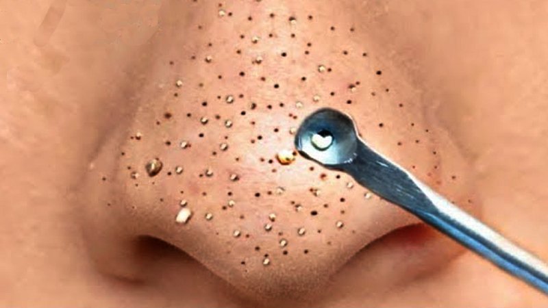 blackheads-2.jpg