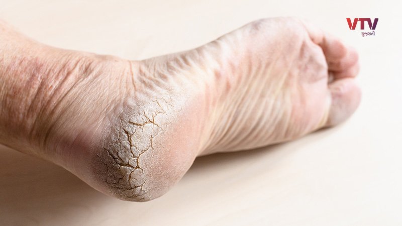 cracked-heels