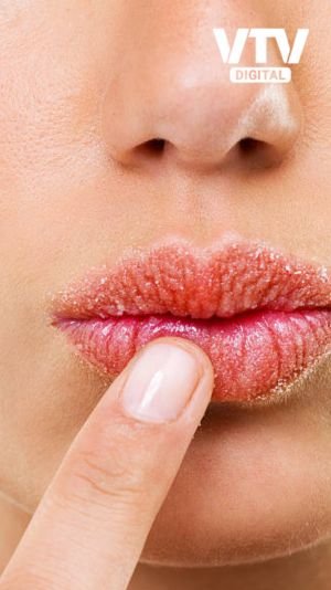 dry lip (5)