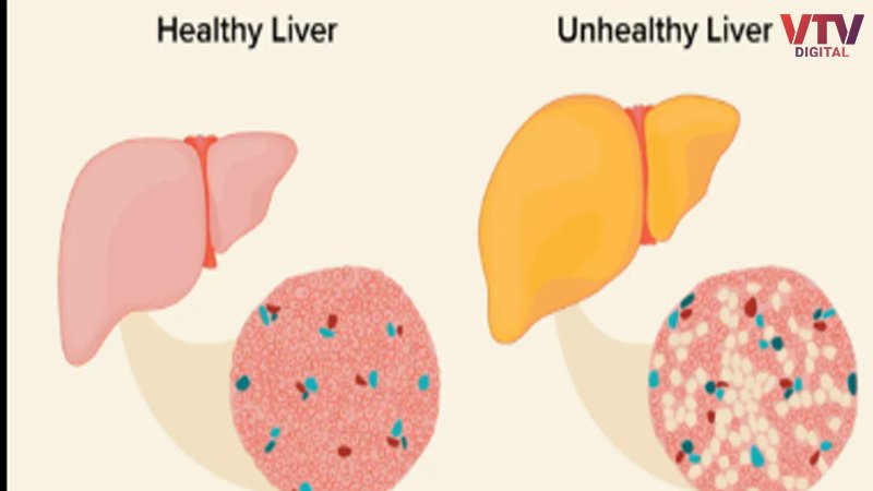 fatty-liver