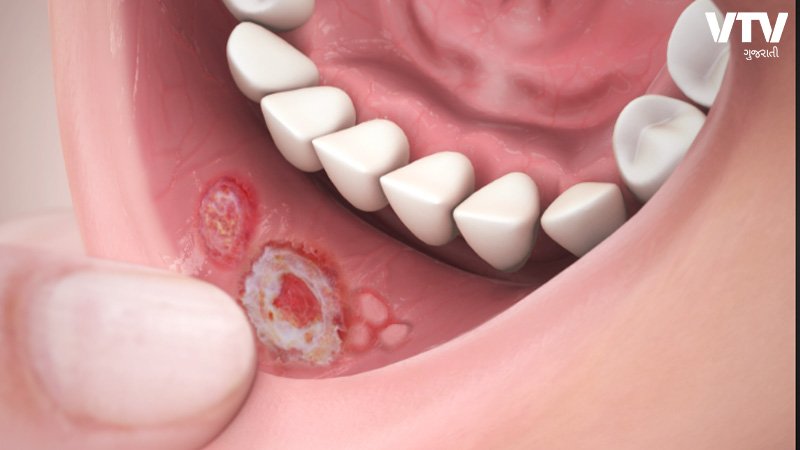 mouth-2